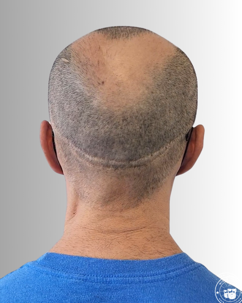 SMP HAIR TRANSPLANT
